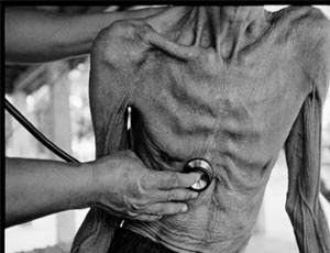 Минздрав Крыма: уровень заболеваемости туберкулезом у крымчан превышает общероссийский