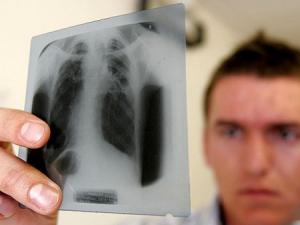 В Крыму больного открытой формой туберкулёза принудительно отправили лечиться